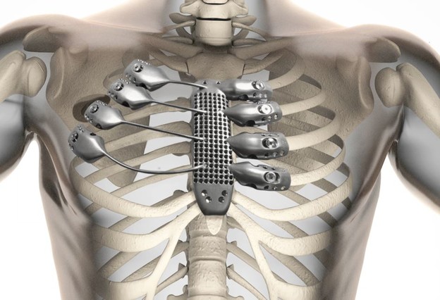 VIDEO: U pacijenta ugrađena prva 3D printana rebra