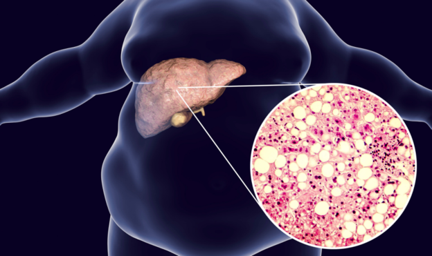 Eksperimentalna terapija liječi masnu jetru
